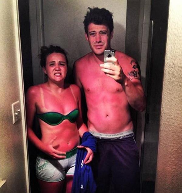 Couples Sunburn