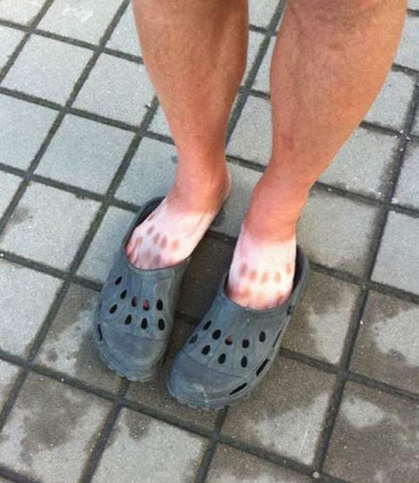 Funny Sunburns Crocs