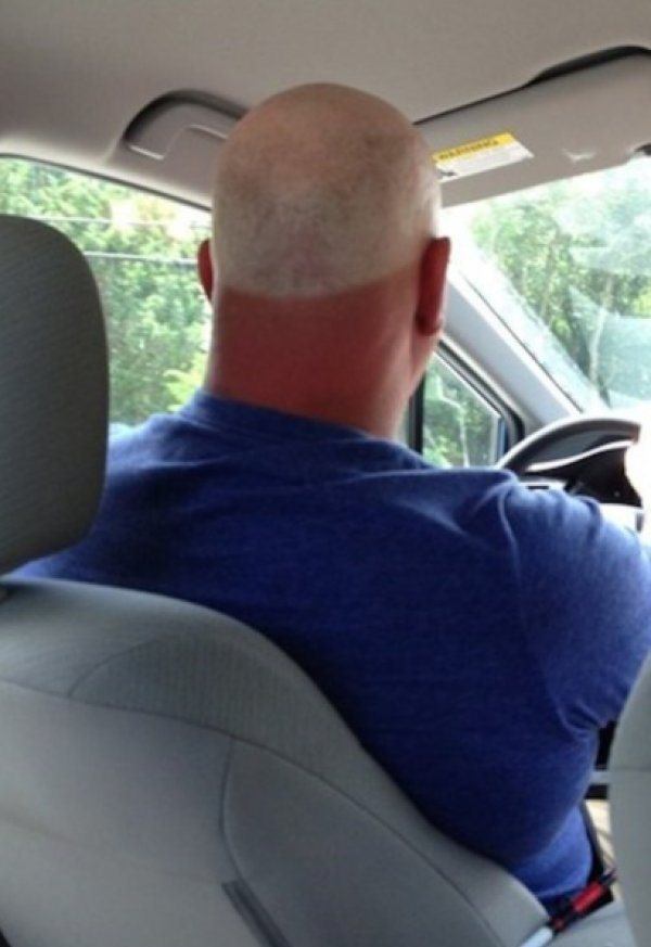 Funny Sunburns Head