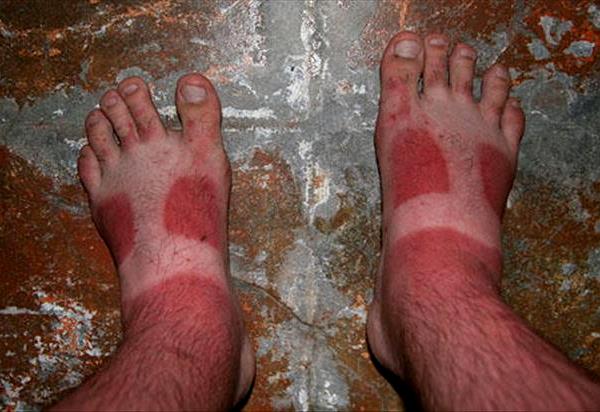 Painful Funny Sunburns