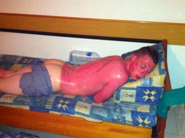 Unfortunate Sunburn